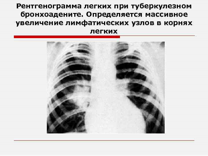 Описание рентгенограммы легких