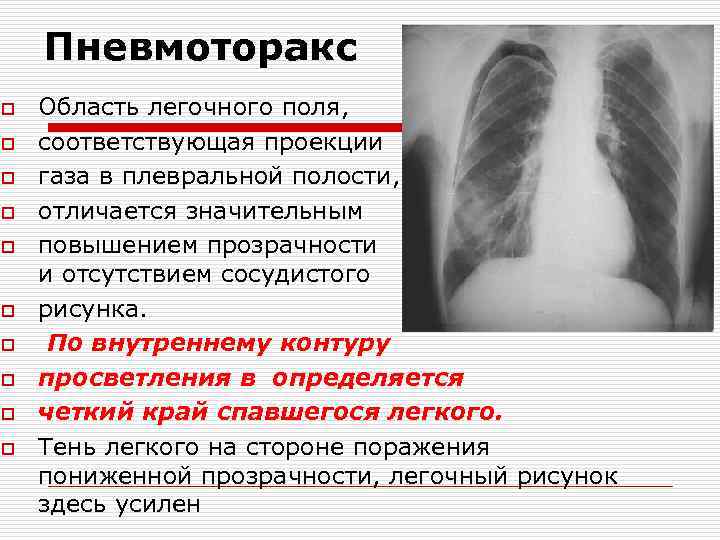 Пневмоторакс o o o o o Область легочного поля, соответствующая проекции газа в плевральной