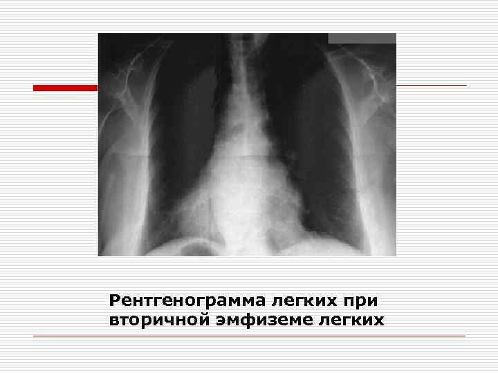 Рентгенограмма легких при вторичной эмфиземе легких 