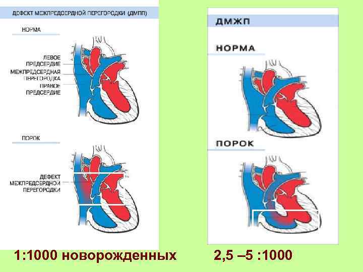 1: 1000 новорожденных 2, 5 – 5 : 1000 