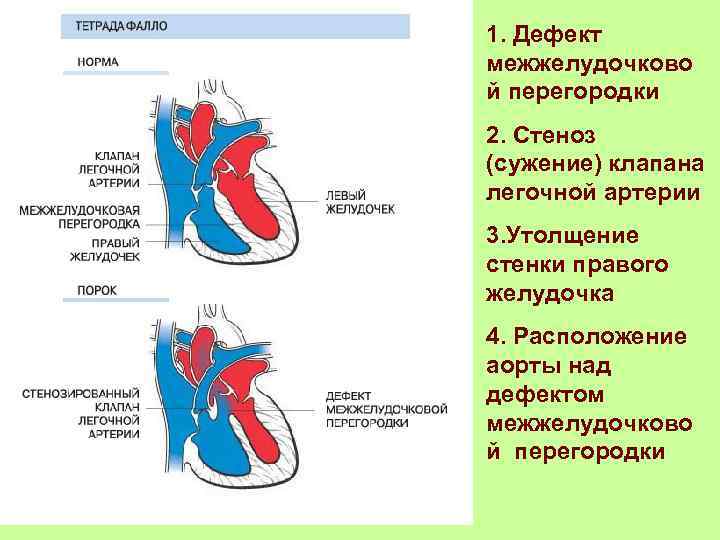 1. Дефект межжелудочково й перегородки 2. Стеноз (сужение) клапана легочной артерии 3. Утолщение стенки