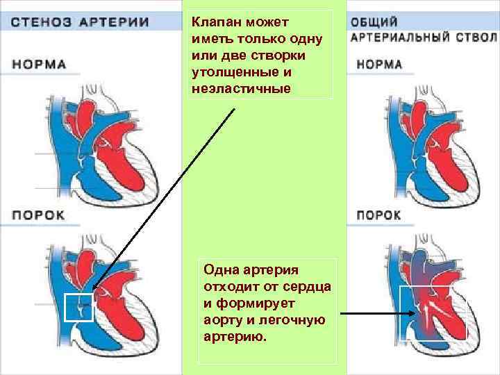 Клапан может иметь только одну или две створки утолщенные и неэластичные Одна артерия отходит