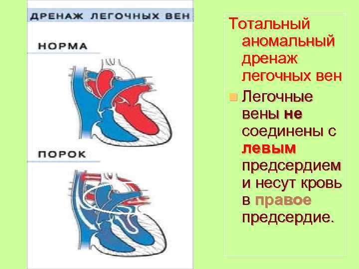 Тотальный аномальный дренаж легочных вен n Легочные вены не соединены с левым предсердием и