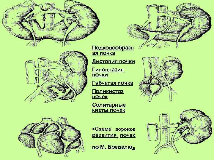 Подковообразн ая почка Дистопия почки Гипоплазия почки Губчатая почка Поликистоз почек Солитарные кисты почек