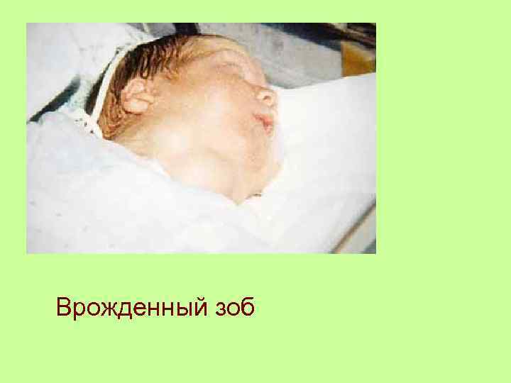 Врожденный зоб 