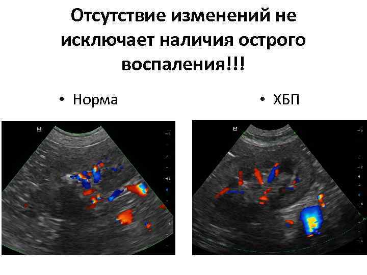 Узи почек и мочевого пермь. УЗИ почек норма. Норма паренхиме в УЗИ. Паренхима почек на УЗИ норма. Нормальная почка на УЗИ.