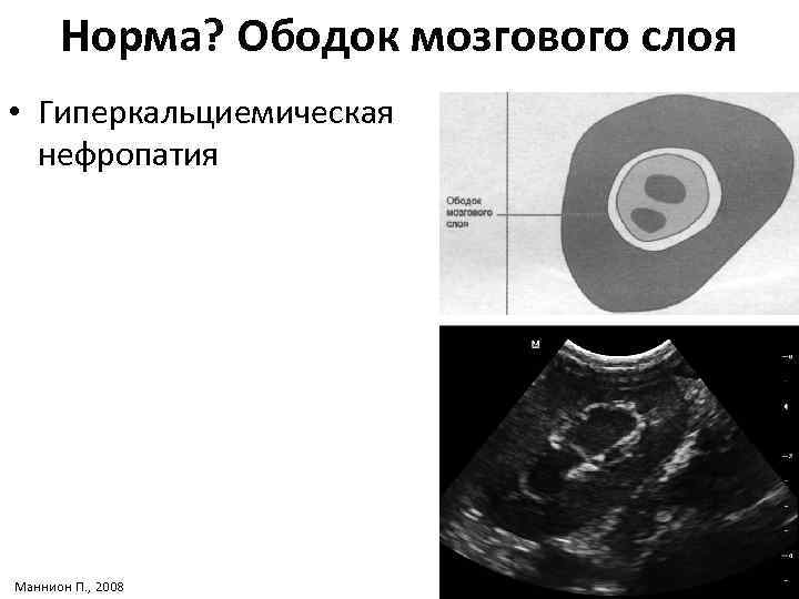 Норма? Ободок мозгового слоя • Гиперкальциемическая нефропатия Маннион П. , 2008 