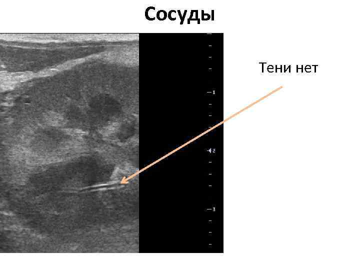 Сосуды Тени нет 