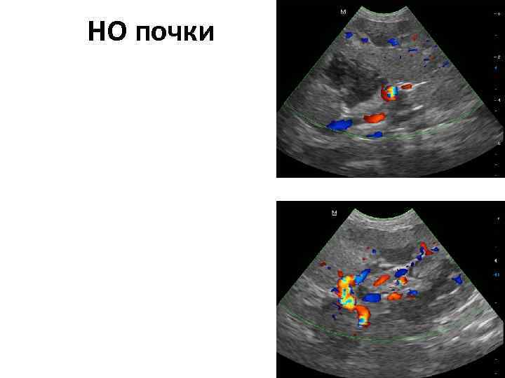 Узи почек подготовка