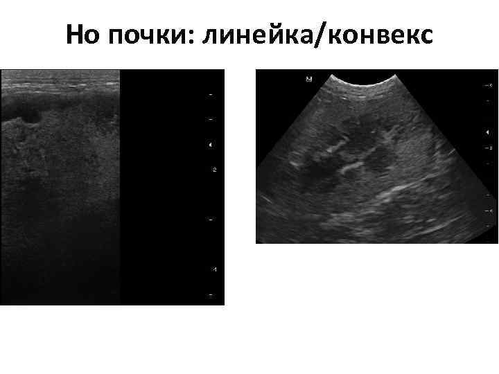 УЗИ почек рисунок. Гидрокаликоз почек на УЗИ. Гемангиолипома почки на УЗИ.