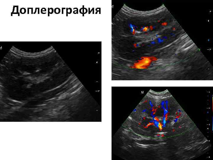 Эхографическая картина почек