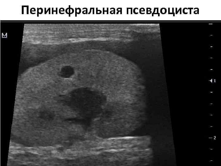 Перинефральная псевдоциста 