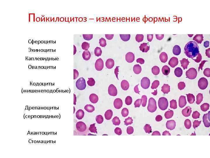 Пойкилоцитоз – изменение формы Эр Сфероциты Эхиноциты Каплевидные Овалоциты Кодоциты (мишенеподобные) Дрепаноциты (серповидные) Акантоциты