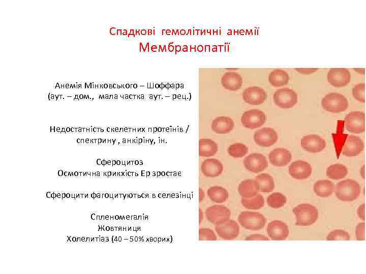 Спадкові гемолітичні анемії Мембранопатії Анемія Мінковського – Шоффара (аут. – дом. , мала частка
