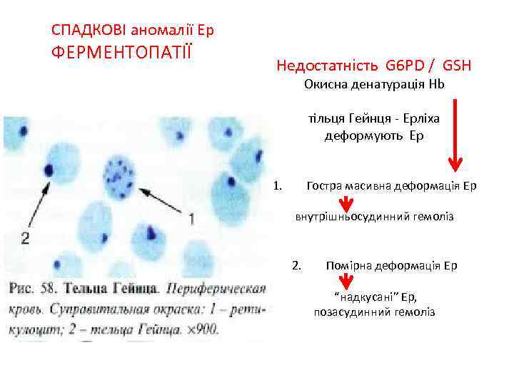 СПАДКОВІ аномалії Ер ФЕРМЕНТОПАТІЇ Недостатність G 6 PD / GSH Окисна денатурація Hb тільця