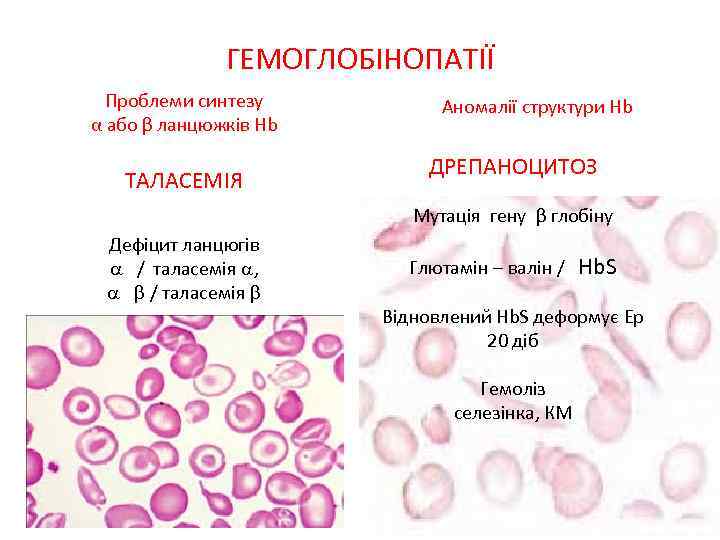 ГЕМОГЛОБІНОПАТІЇ Проблеми синтезу α або β ланцюжків Hb Аномалії структури Hb ДРЕПАНОЦИТОЗ ТАЛАСЕМІЯ Мутація