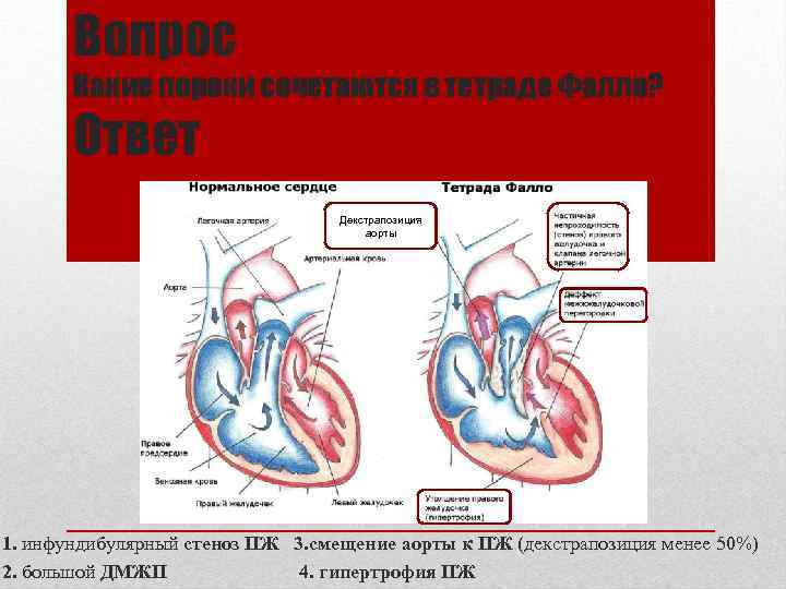 Вопрос Какие пороки сочетаются в тетраде Фалло? Ответ Декстрапозиция аорты 1. инфундибулярный стеноз ПЖ