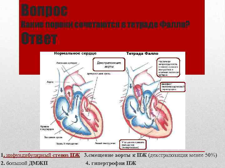 Вопрос Какие пороки сочетаются в тетраде Фалло? Ответ Декстрапозиция аорты 1. инфундибулярный стеноз ПЖ