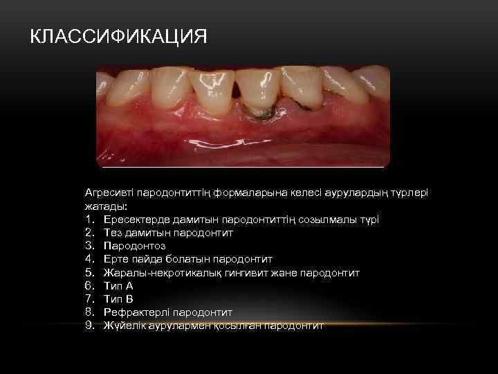 КЛАССИФИКАЦИЯ Агресивті пародонтиттің формаларына келесі аурулардың түрлері жатады: 1. Ересектерде дамитын пародонтиттің созылмалы түрі