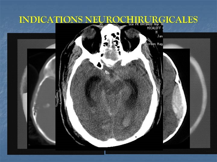 INDICATIONS NEUROCHIRURGICALES PRECOCES évacuation la plus précoce possible d’HED symptomatique évacuation HSD (> 5
