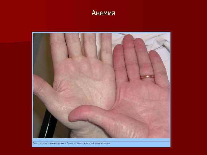 Анемия 