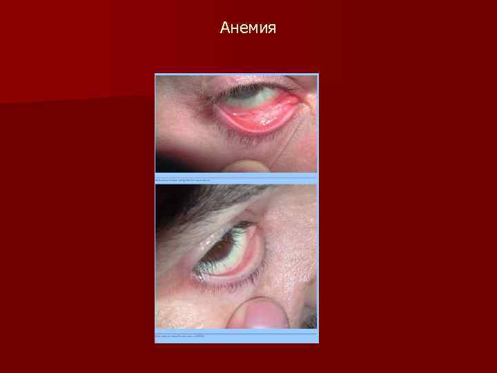 Анемия 