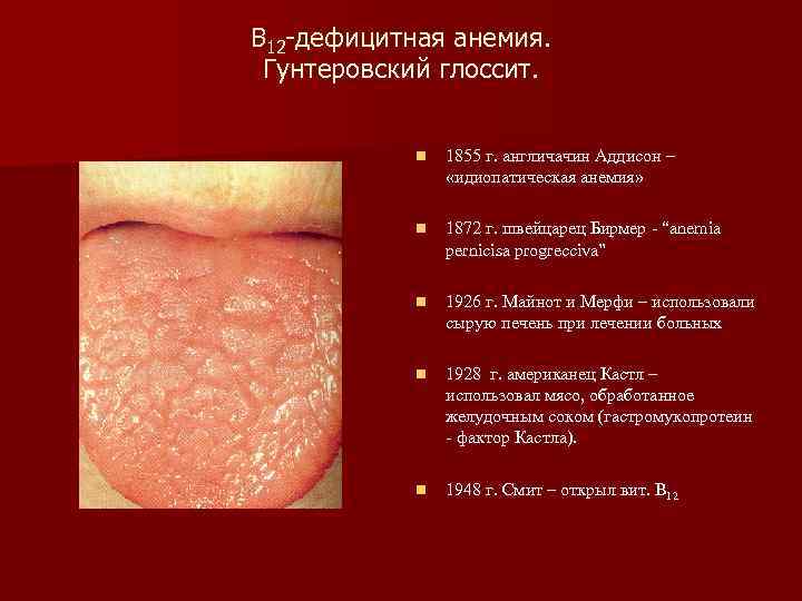 В 12 -дефицитная анемия. Гунтеровский глоссит. n 1855 г. англичачин Аддисон – «идиопатическая анемия»