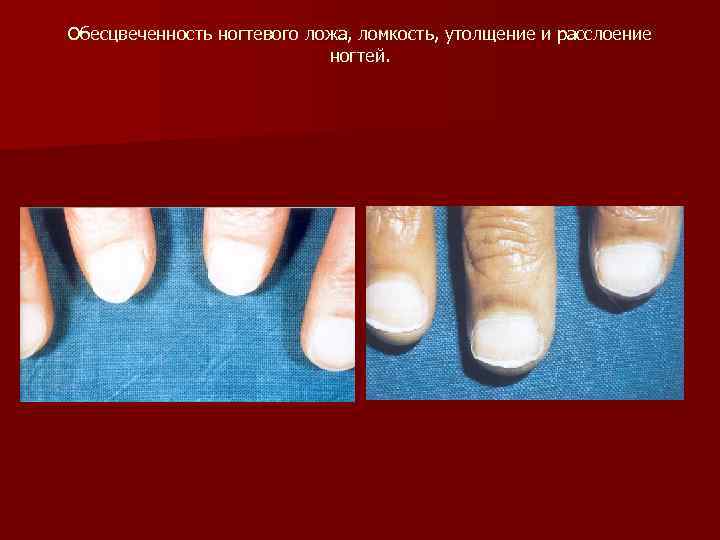 Обесцвеченность ногтевого ложа, ломкость, утолщение и расслоение ногтей. 