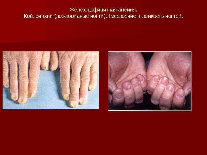 Железодефицитная анемия. Койлонихии (ложковидные ногти). Расслоение и ломкость ногтей. 