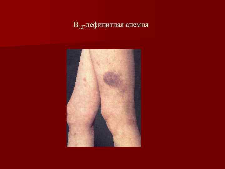 В 12 -дефицитная анемия 