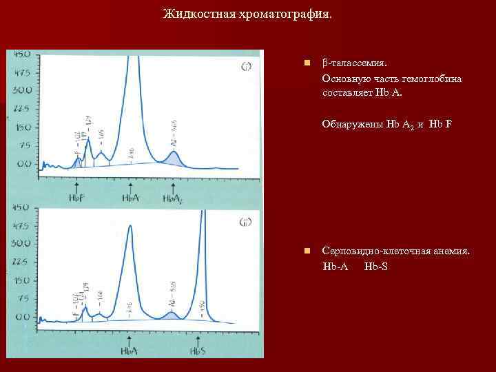 Жидкостная хроматография. n β-талассемия. Основную часть гемоглобина составляет Hb A. Обнаружены Hb A 2