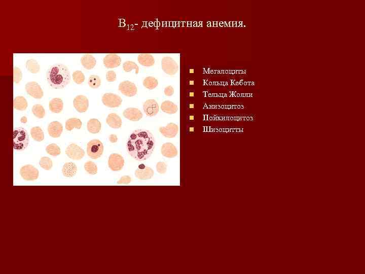 В 12 - дефицитная анемия. n n n Мегалоциты Кольца Кебота Тельца Жолли Анизоцитоз
