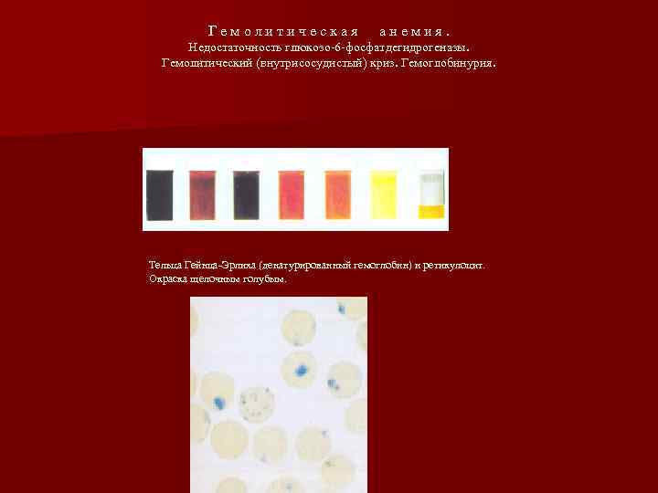 Гемолитическая анемия. Недостаточность глюкозо-6 -фосфатдегидрогеназы. Гемолитический (внутрисосудистый) криз. Гемоглобинурия. Тельца Гейнца-Эрлиха (денатурированный гемоглобин) и