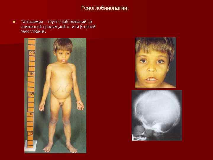 Гемоглобинопатии. n Талассемия – группа заболеваний со сниженной продукцией α- или β-цепей гемоглобина. 