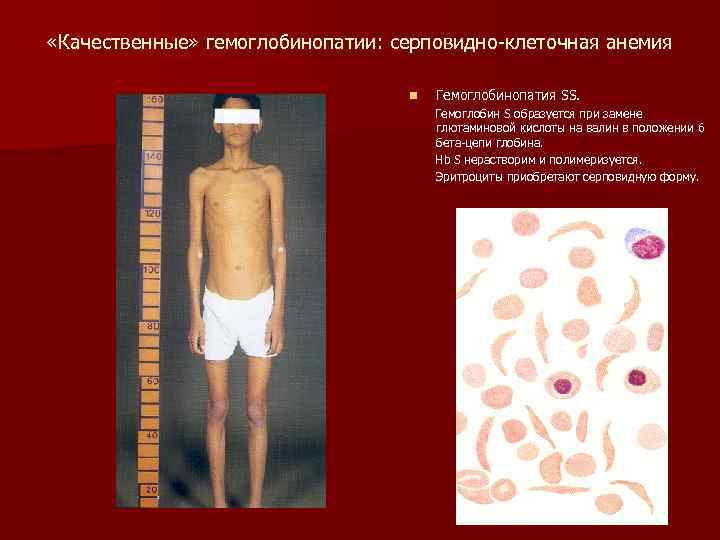  «Качественные» гемоглобинопатии: серповидно-клеточная анемия n Гемоглобинопатия SS. Гемоглобин S образуется при замене глютаминовой