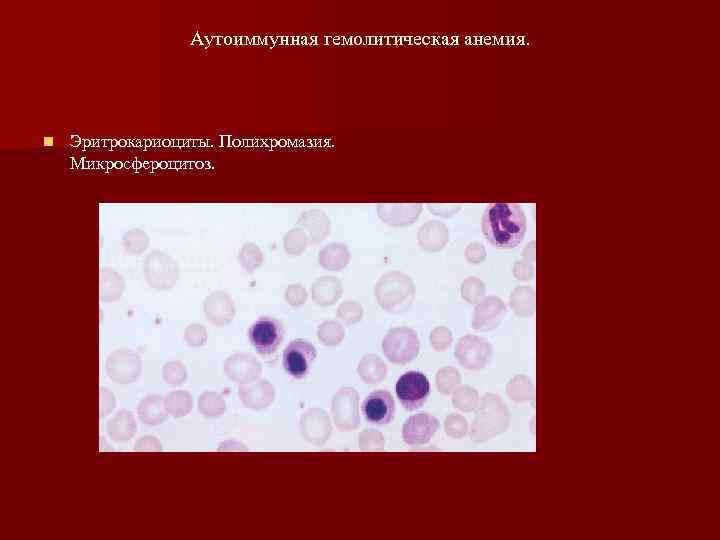 Аутоиммунная гемолитическая анемия. n Эритрокариоциты. Полихромазия. Микросфероцитоз. 