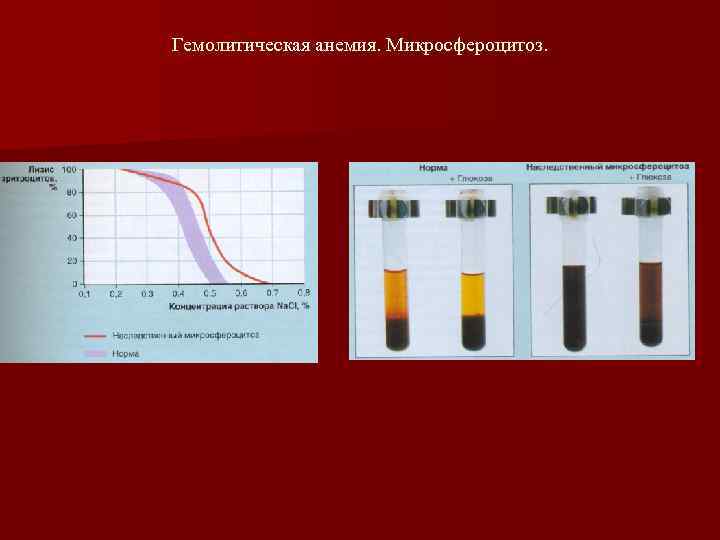 Гемолитическая анемия. Микросфероцитоз. 