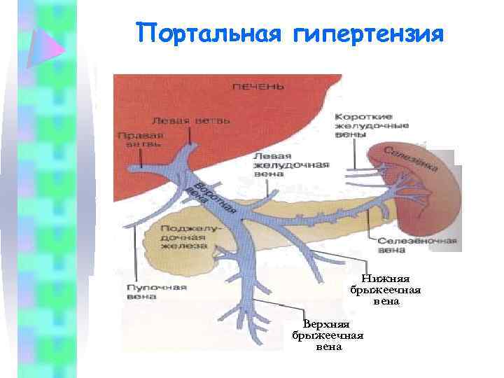Портальная гипертензия Нижняя брыжеечная вена Верхняя брыжеечная вена 