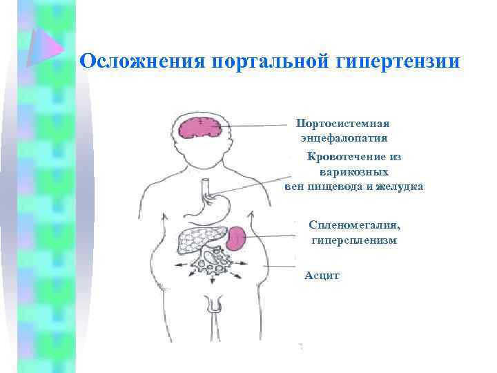 Цирроз печени кровотечение из варикозно