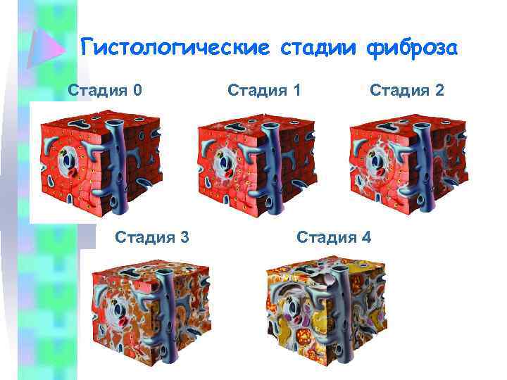 Гистологические стадии фиброза Стадия 0 Фиброза нет Стадия 1 Портальный фиброз Единичные септы Стадия