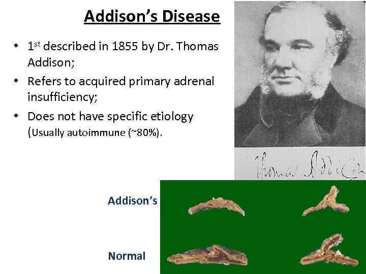 Addison’s Disease • 1 st described in 1855 by Dr. Thomas Addison; • Refers