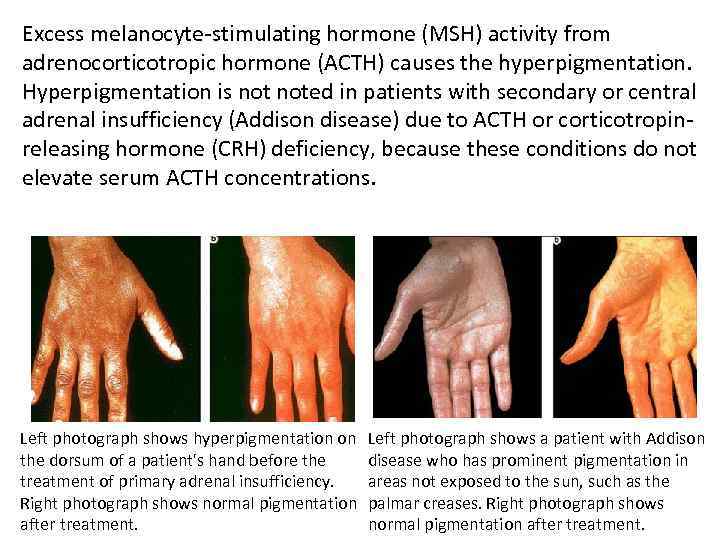 Excess melanocyte-stimulating hormone (MSH) activity from adrenocorticotropic hormone (ACTH) causes the hyperpigmentation. Hyperpigmentation is