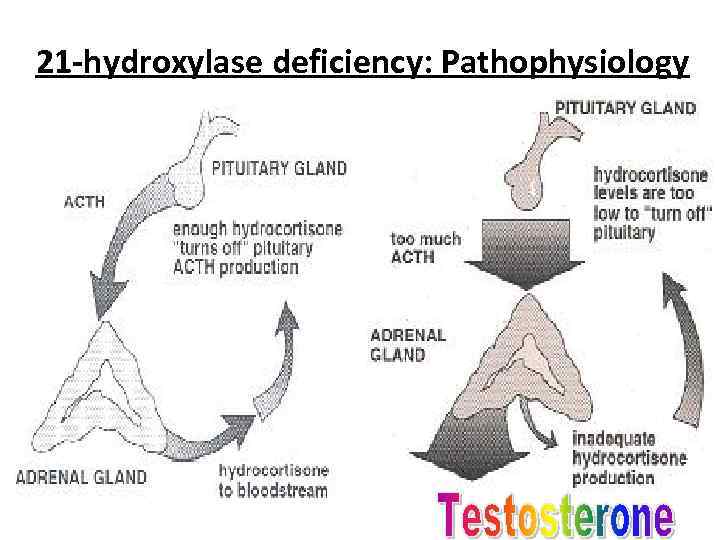 21 -hydroxylase deficiency: Pathophysiology 