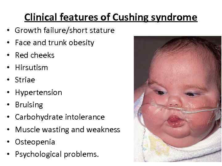 Clinical features of Cushing syndrome • • • Growth failure/short stature Face and trunk