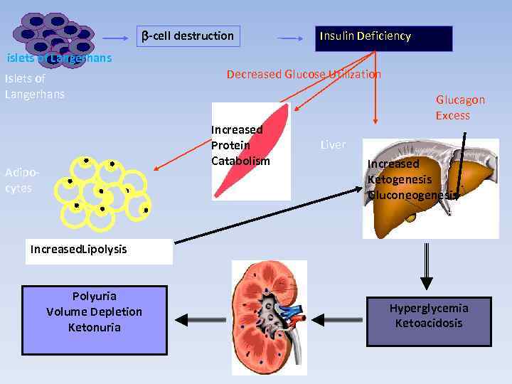 b-cell destruction Insulin Deficiency islets of Langerhans Islets of Langerhans Decreased Glucose Utilization Increased