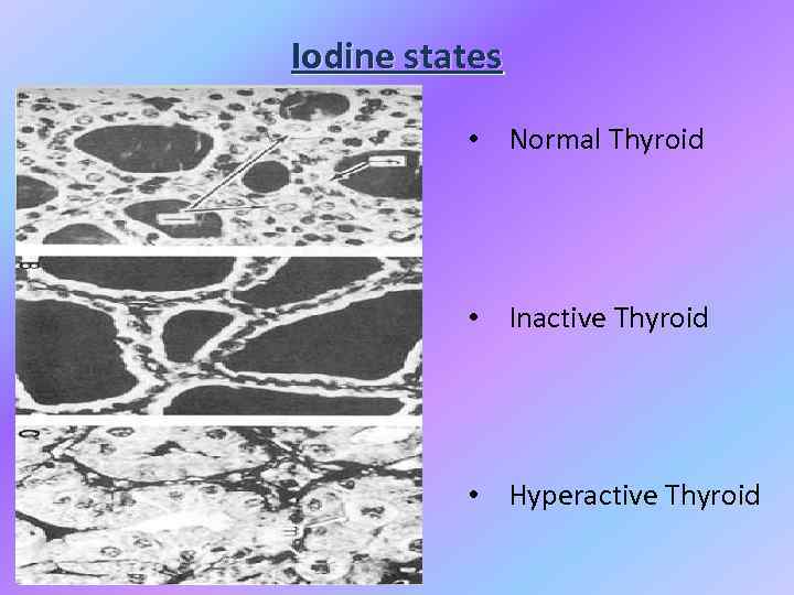 Iodine states • Normal Thyroid • Inactive Thyroid • Hyperactive Thyroid 