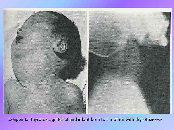 Congenital thyrotoxic goiter of and infant born to a mother with thyrotoxicosis 