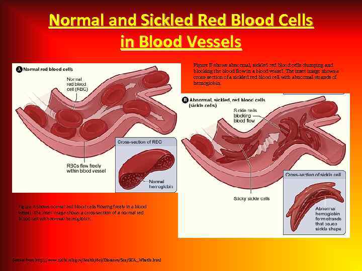 Normal and Sickled Red Blood Cells in Blood Vessels Figure B shows abnormal, sickled
