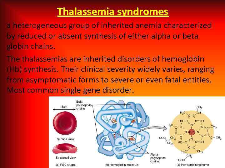 Thalassemia syndromes a heterogeneous group of inherited anemia characterized by reduced or absent synthesis