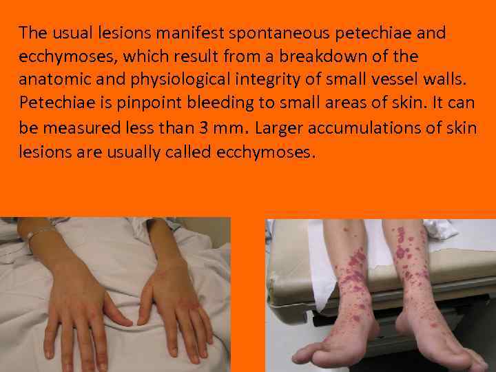 The usual lesions manifest spontaneous petechiae and ecchymoses, which result from a breakdown of